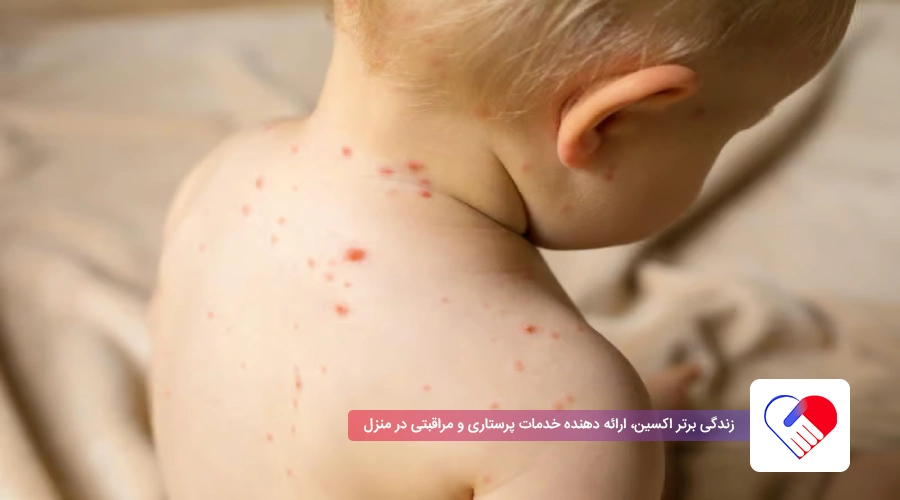 شکل جوشهای سرخک در کودکان شکل جوشهای سرخک در کودکان