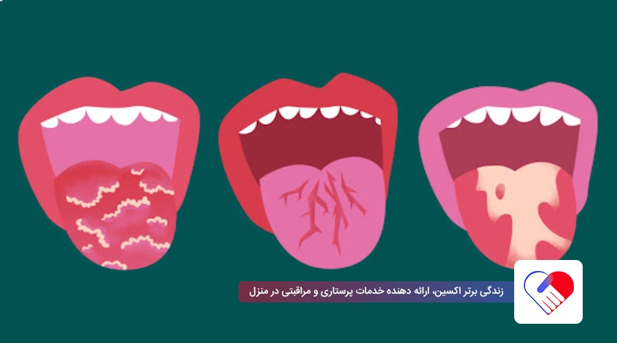 پسوریازیس دهانی؛ علت، علائم و درمان آن 2 تشخیص پسوریازیس دهانی