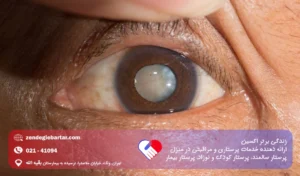 آب مروارید در سالمندان