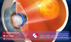 دژنراسیون ماکولا چیست؛ علت ها و روش های درمان آن