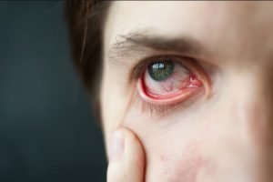 بیماری خستگی چشم