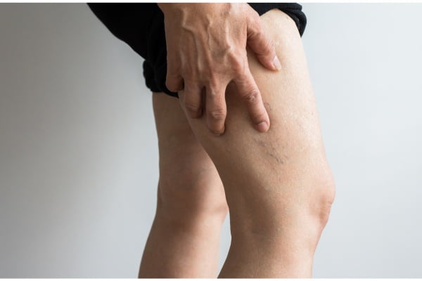 ورم پا در سالمندان | علل، علائم روش های درمان ورم پا سالمند