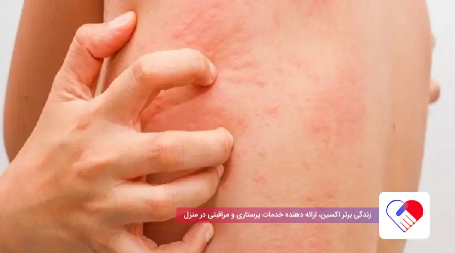 درماتیت عصبی درماتیت عصبی