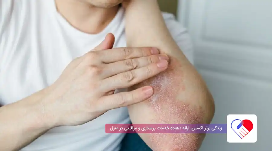 درمان اگزمای عصبی درمان اگزمای عصبی