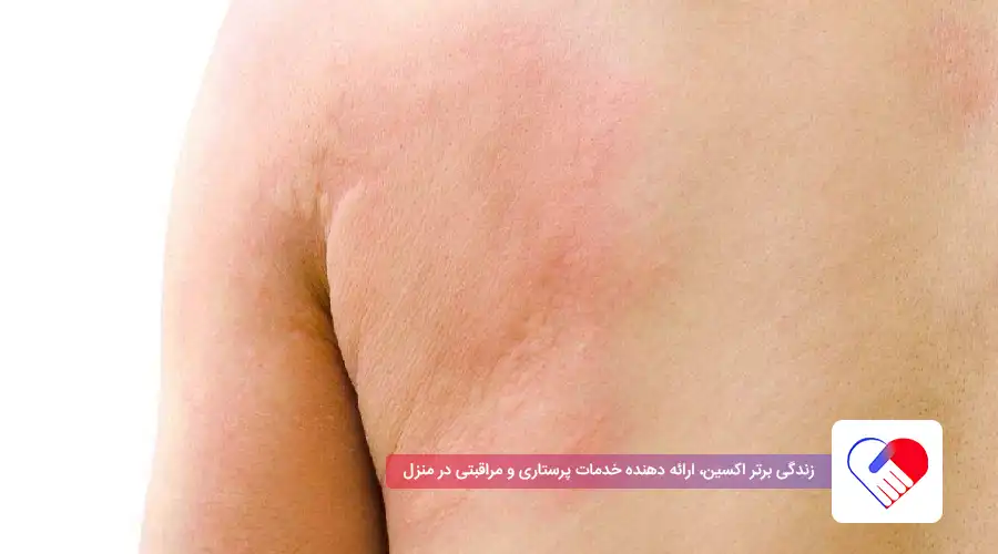 اگزمای عصبی شدید اگزمای عصبی شدید