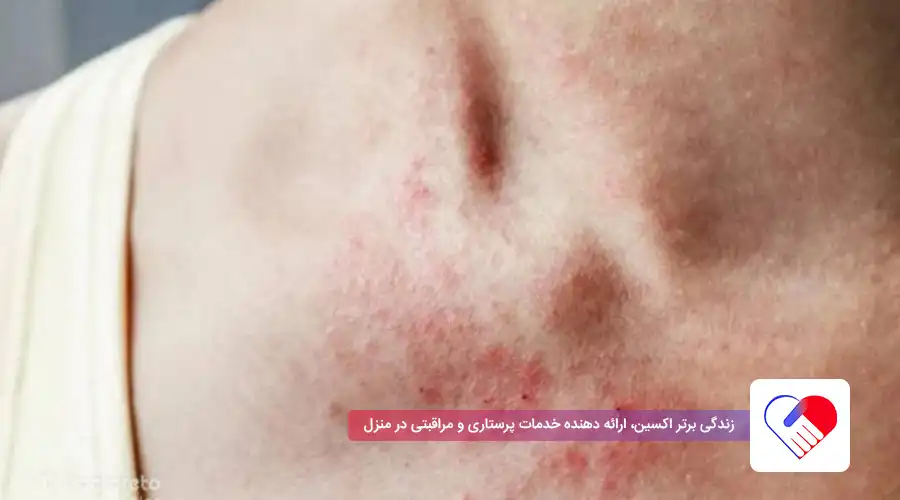 اگزمای عصبی با خارش اگزمای عصبی با خارش