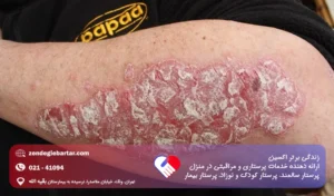 پسوریازیس چیست؟