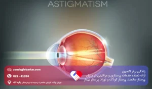 آستیگمات چشم چیست؟