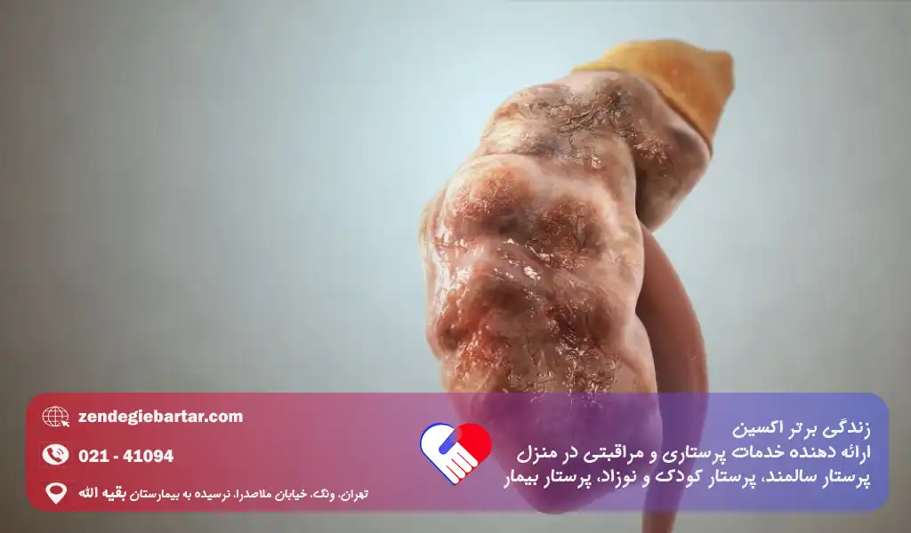 نارسایی کلیه در سالمندان | علائم خطرناکی که نباید نادیده بگیرید 1 نارسایی کلیه در سالمندان چیست و یه چه دلیل رخ میدهد؟