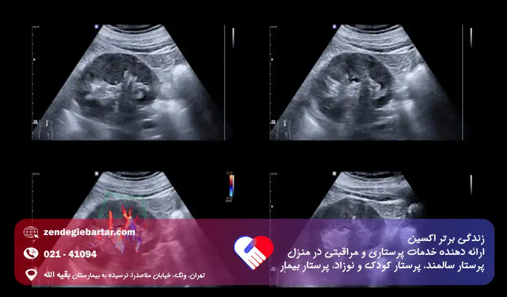 نارسایی کلیه در سالمندان | علائم خطرناکی که نباید نادیده بگیرید 4 پزشک برای بررسی ساختار کلیهها و مجاری ادراری، از سونوگرافی، سیتیاسکن یا امآرآی استفاده میکند.