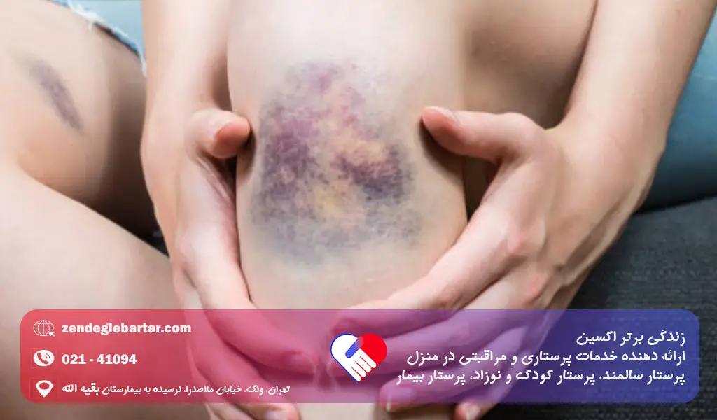 کبود شدن بی دلیل بدن و نشانه های خطرناک 1 کبودی بدن نشانه چیست