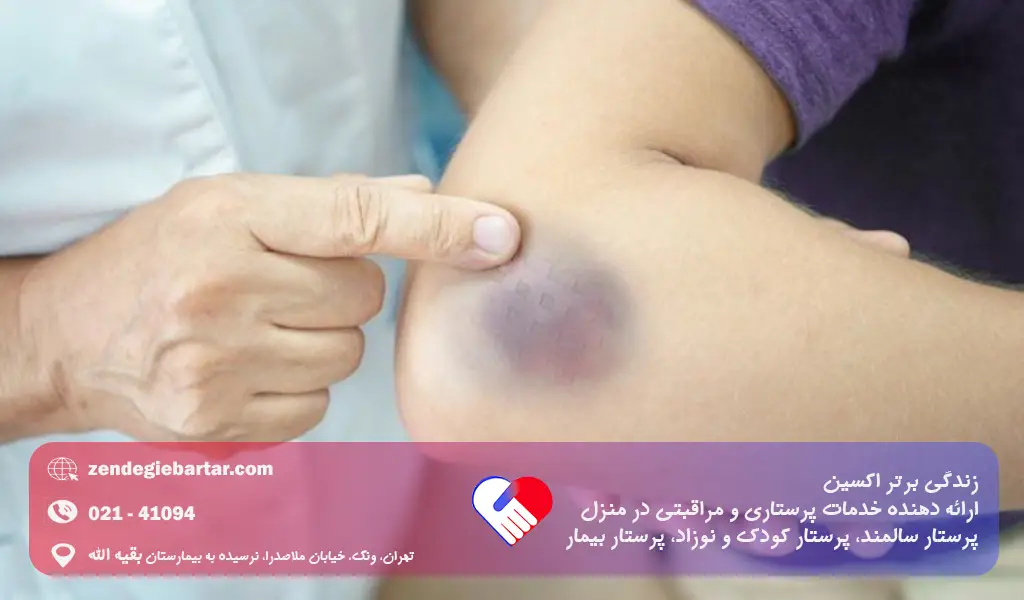 علت کبود شدن بی دلیل بدن