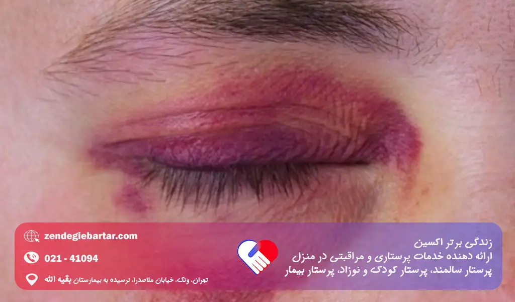 کبود شدن بی دلیل بدن و نشانه های خطرناک 3 درمان کبودی و خونمردگی