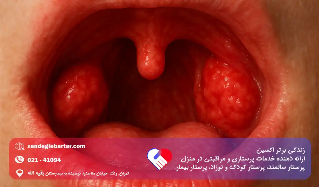 گلودردها را می‌توان بر اساس محل التهاب و بافت‌های درگیر در گلو به سه نوع اصلی تقسیم کرد.